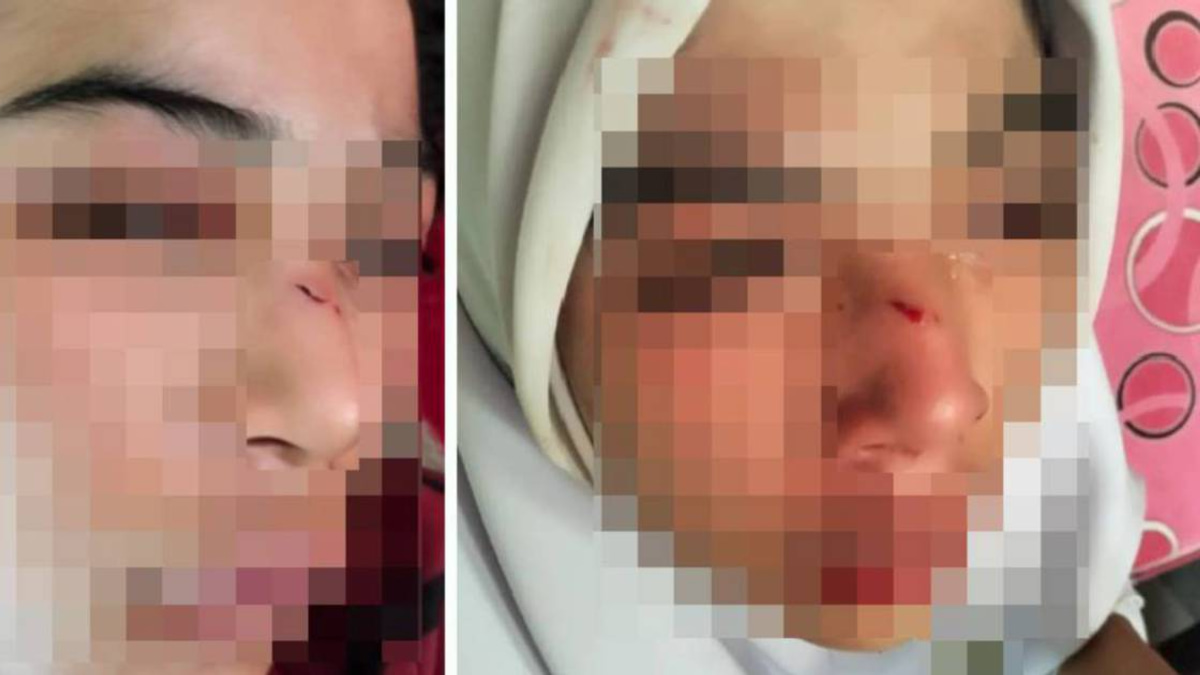 Kelantan Education Department Investigates Alleged Assault on Student Who Suffered Fractured Nose