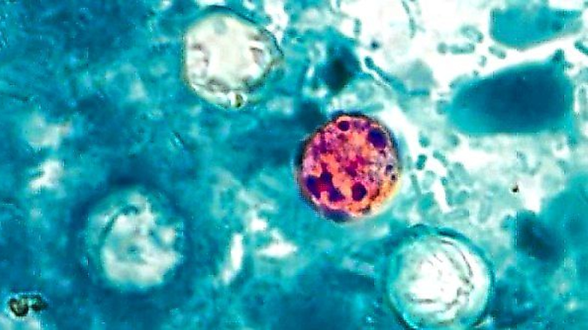 The Detection Dilemma: Why Cyclospora Outbreaks Remain Difficult to Contain